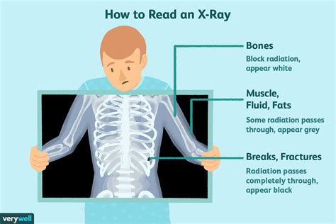 how many months does xray last|How Many X.